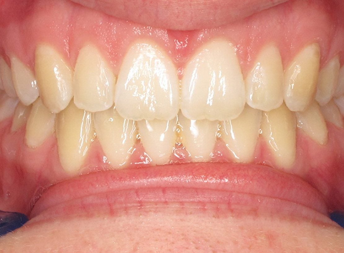 After Invisalign (gap teeth)